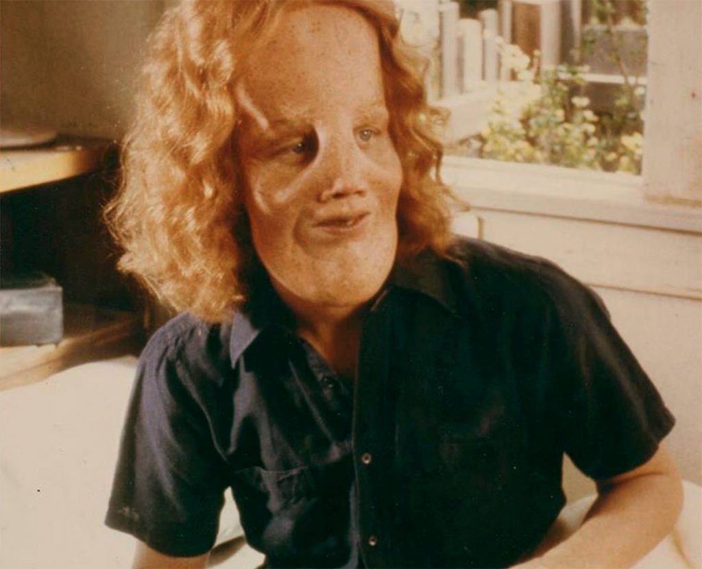 10 Heart-Rending Facts About Rocky Dennis, Whose Rare Deformity Was The