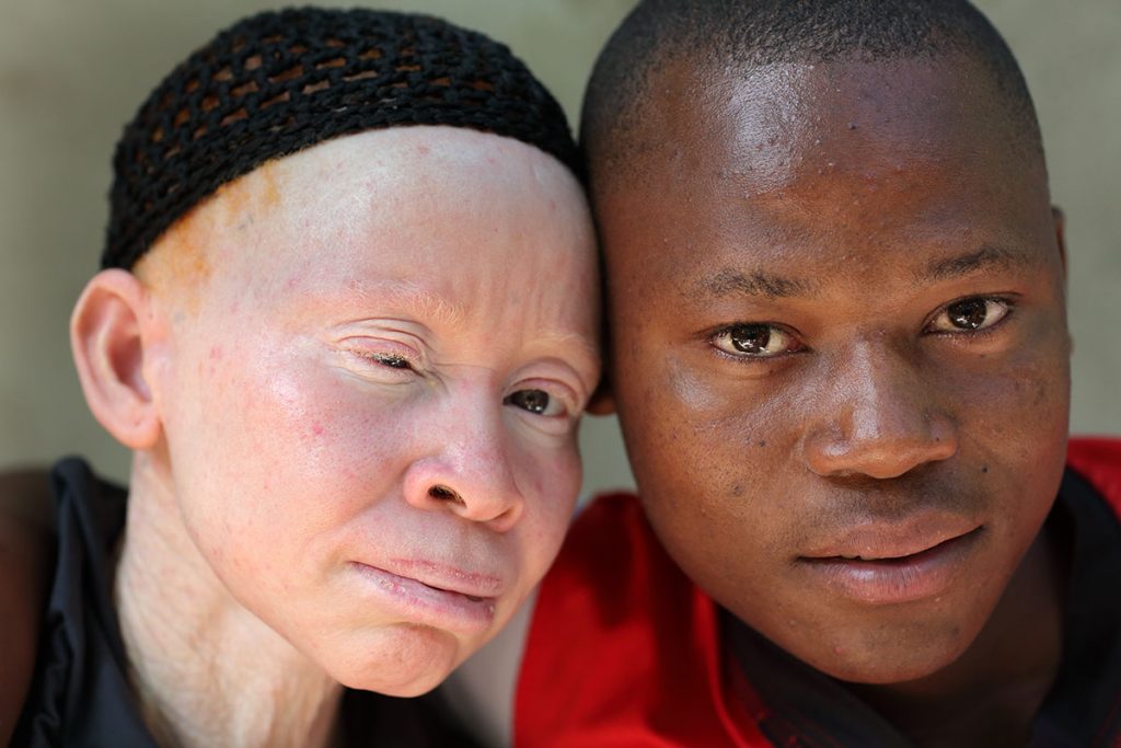 10 Heart Wrenching Details Surrounding Djeneba Diarra The Five Year Old Albino Child Who Was 